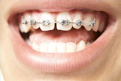 niềng răng không nhổ răng trong trường hợp nào? 2
