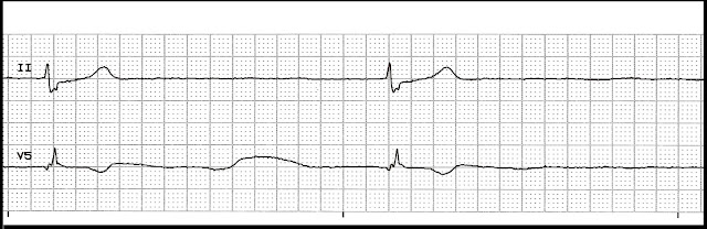 Float Nurse: Basic EKG Test 49