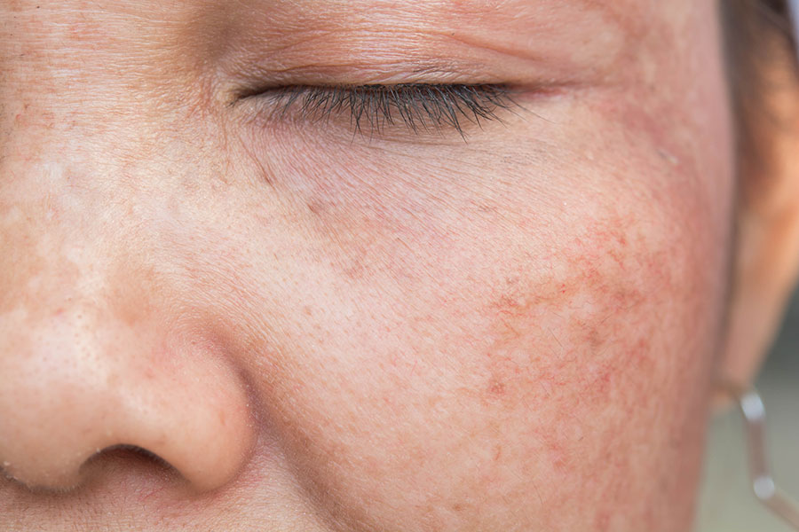 Sun Damage On The Skin Tips You Need To Learn Now