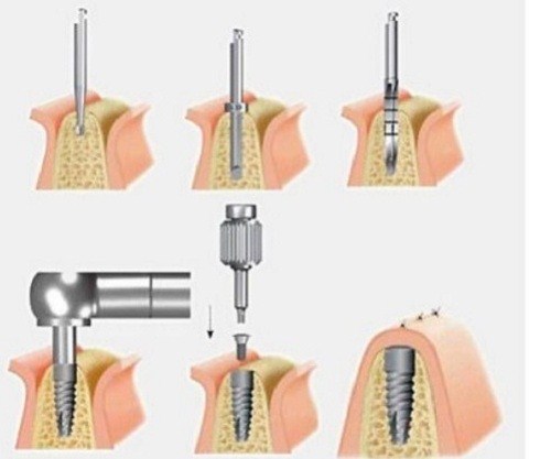 CẮM GHÉP IMPLANT KHÔNG ĐÚNG QUY TRÌNH VÀ NHỮNG BIẾN CHỨNG -7