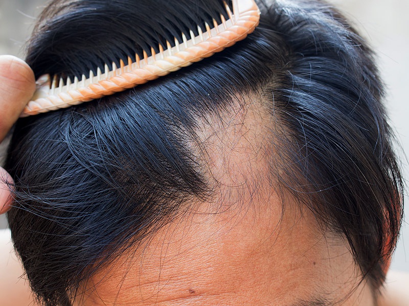 10 Best Natural Supplements for Hair Loss