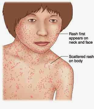 Scarlet fever Symptoms - Mayo Clinic