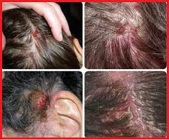 OBAT GATAL DI KEPALA TIMBUL BENJOLAN DITEKAN KELUAR CAIRAN BENING OBAT GATAL DI KEPALA TIMBUL BENJOLAN DITEKAN KELUAR CAIRAN BENING