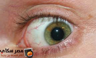 مرض جفاف العين وأسبابة وأعراضة Dry eyes