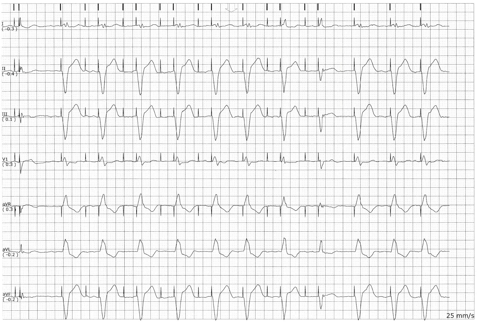 pacemaker failure to capture pacemaker failure to capture
