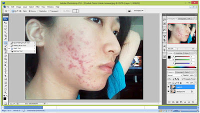 Tips Menghilangkan Jerawat Menggunakan Photoshop