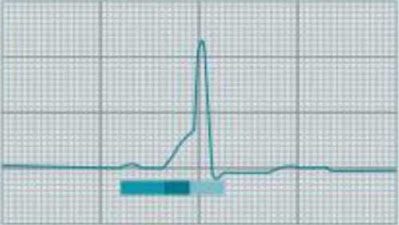 Magnified ECG tracing