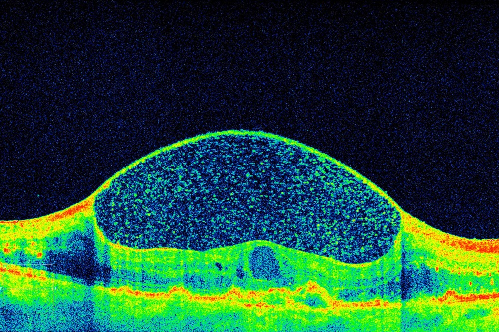 Retina Eye Specialist Melbourne Why to Consult an Eye Doctor for