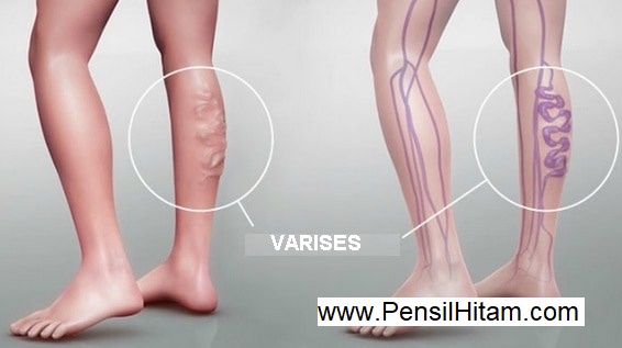 Varises - Gejala, Penyebab dan Cara Mengobati