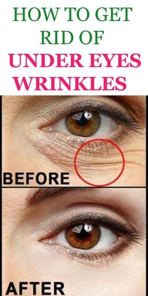 How To Get Rid Of Wrinkles Under Your Eyes Naturally SKINCARE