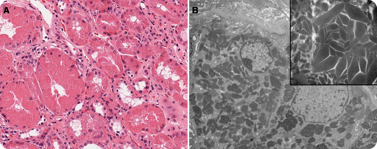 Clinical A case of heavy chain deposition disease complicated by