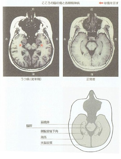 Fig.2  うつ病の扁桃体の傷と正常者の比較　MRI