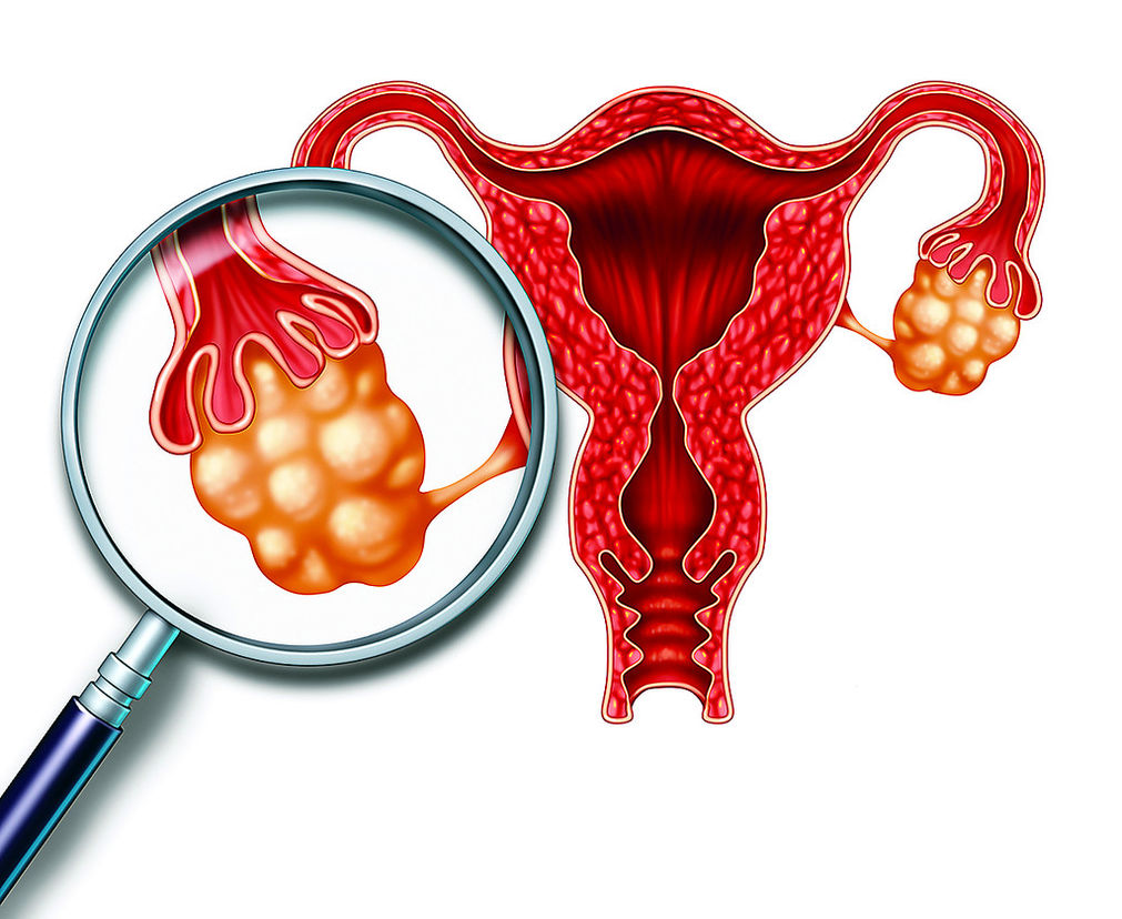 SALUD PARA TI CÓMO PREVENIR LOS QUISTES EN LOS OVARIOS SALUD PARA TI CÓMO PREVENIR LOS QUISTES EN LOS OVARIOS