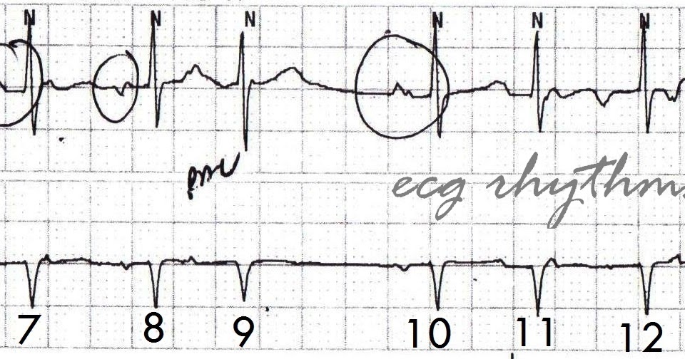 ECG Rhythms WAP/MAR/MAT/Sinus arrhythmia
