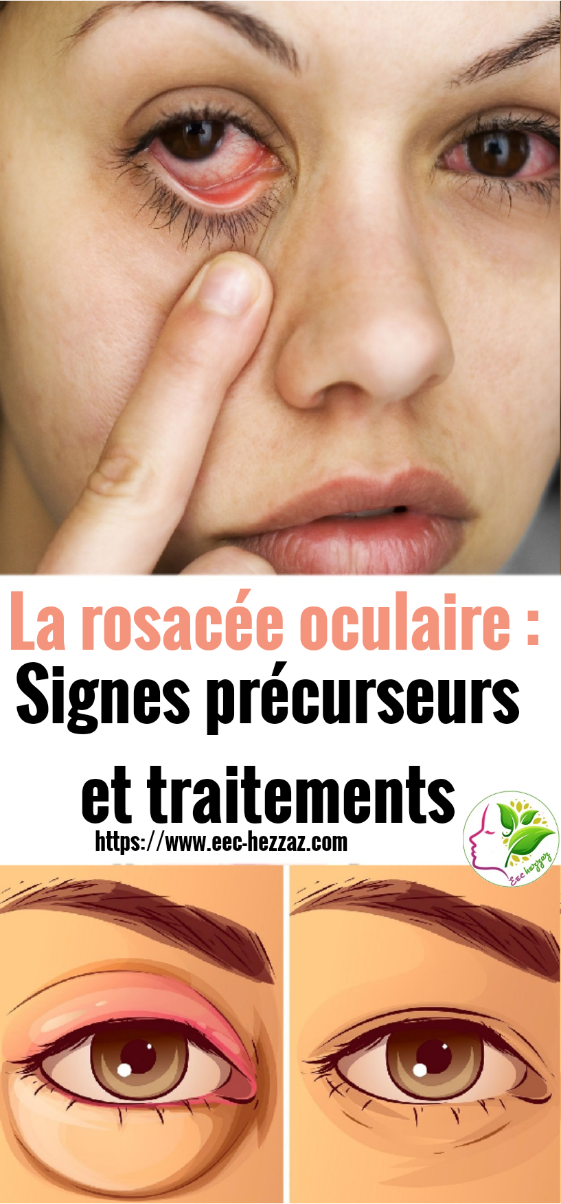 La rosacée oculaire : Signes précurseurs et traitements