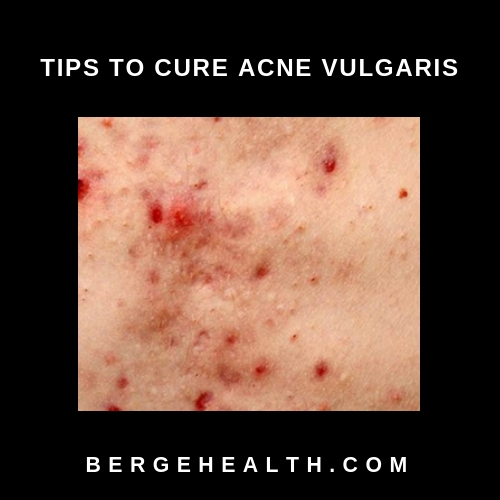 Tips to Cure Acne Vulgaris