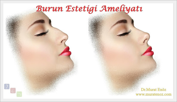 Burun Eti Büyümesi (Konka Hipertrofisi)