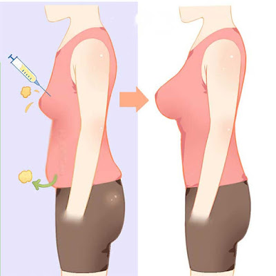 Fat transfer breast augmentation pros and cons