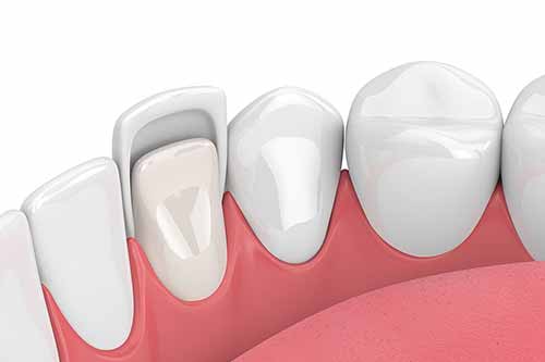 FACCETTA DENTALE PER RICOPRIRE IL DENTE NATURALE