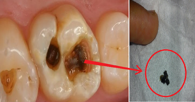 Cara menghilangkan sakit gigi berlubang agar tidak kambuh lagi