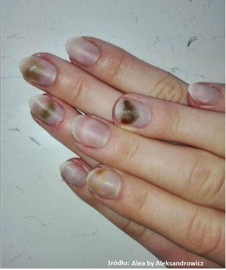 Mani Pedi Studio Zespol Zielonego Paznokcia Przyczyny Leczenie