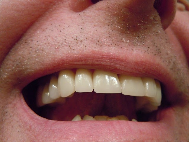 Zähne kaputte Setzen Zahnärzte
