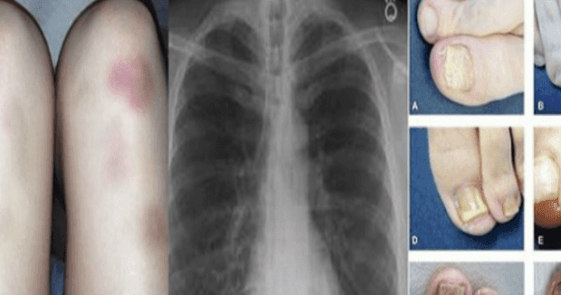 OBRATITE PAŽNJU: OVO SU NAJRANIJI ZNAKOVI DA RAK RASTE U VAŠEM TIJELU