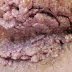 OBAT KUTIL KELAMIN HERBAL thumbnail