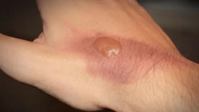 Cara Mengobati Luka Bakar yang Menggelembung Agar Cepat Kering