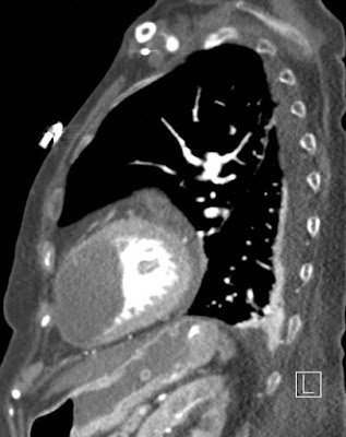 Golyóthrombus a bal kamrában