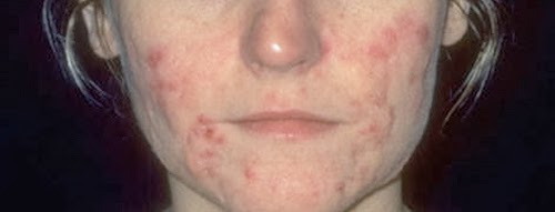 tratamientos contra el acne