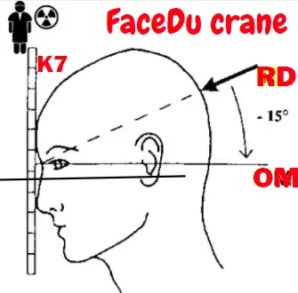 Incidence De Face Du Crane