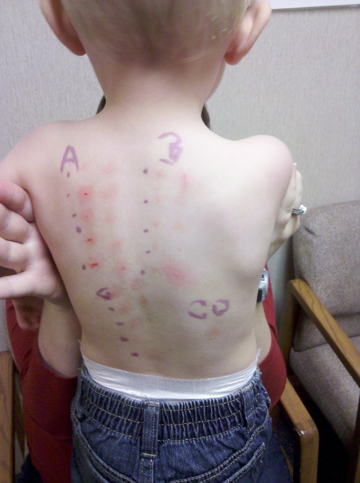 Michel Spot Allergy Testing Take 2