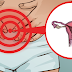 4 Early Signs and Symptoms of Ovarian Cancer That Every Girls Should Know before It’s too late!