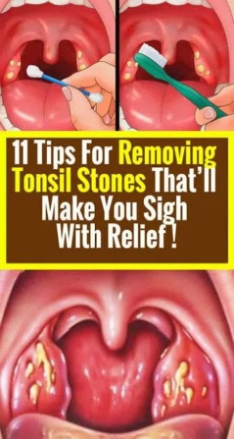 Tips On Removing Tonsil Stones With Relief Healthy Lifestyle