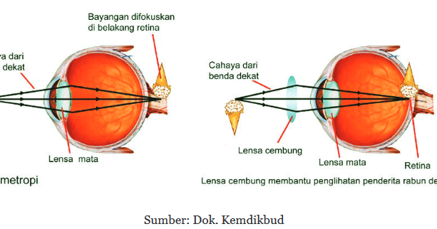 Wawan Listyawan Materi Cahaya Dan Optik Part 8 Rabun Dekat Dan Rabun Jauh
