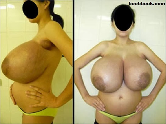 Gigantomastia Breasts.