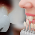 Những ưu điểm của răng sứ thẩm mỹ