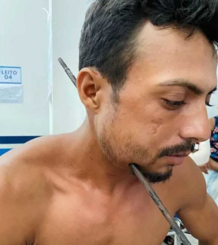 Homem sobrevive após ferro atravessar pescoço e crânio no Pará