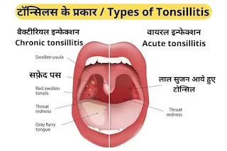 टॉन्सिल का होम्योपैथिक इलाज, Tonsillitis treatment in homeopathy hindi, टॉन्सिलाइटिस के प्रकार
