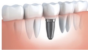 Dental Implants Oakville ON