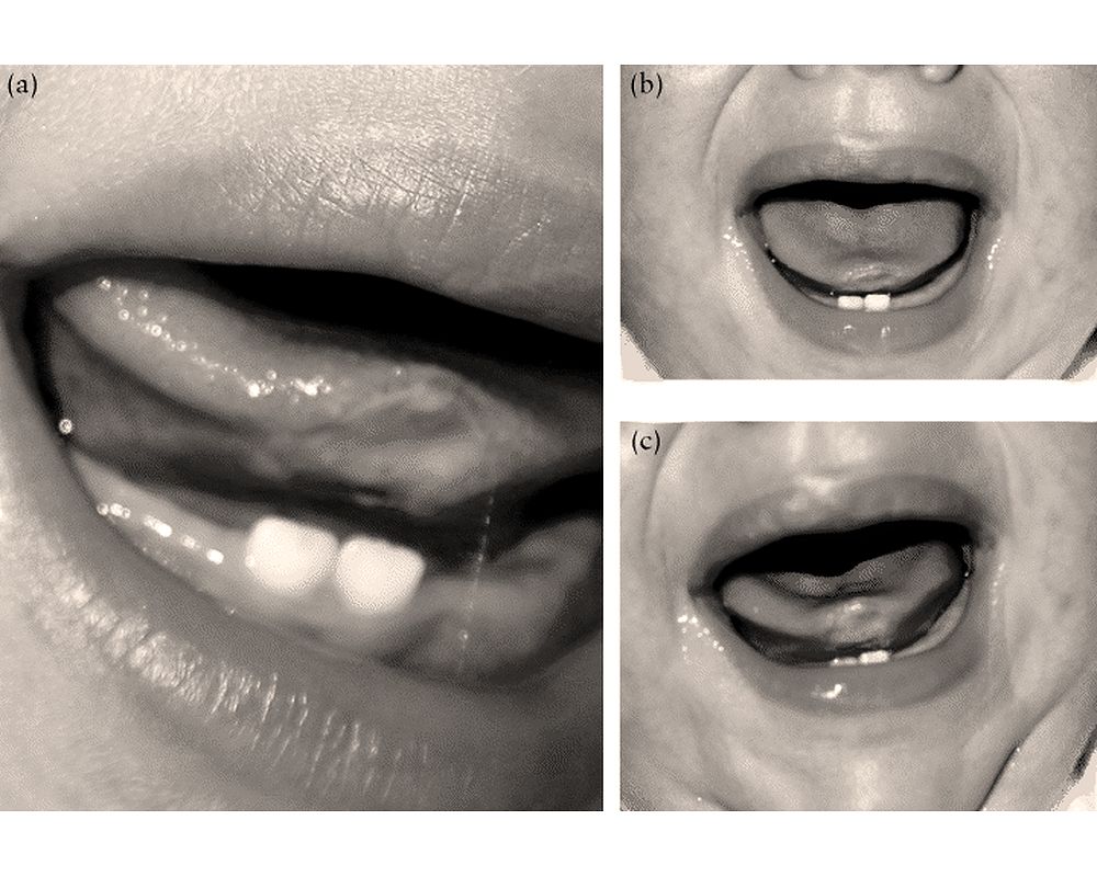 Neonatal tooth with RigaFede disease affecting breastfeeding A case