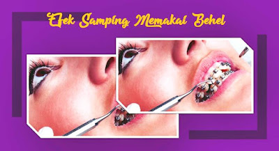 efek samping memakai kawat gigi efek samping memakai behel
