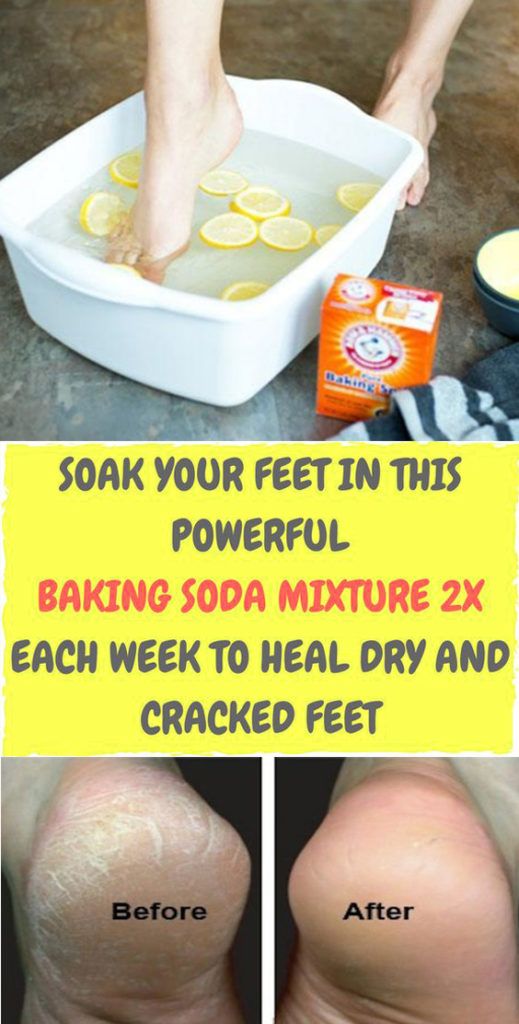Soak Your Feet in This Powerful Baking Soda Mixture 2x Each Week To