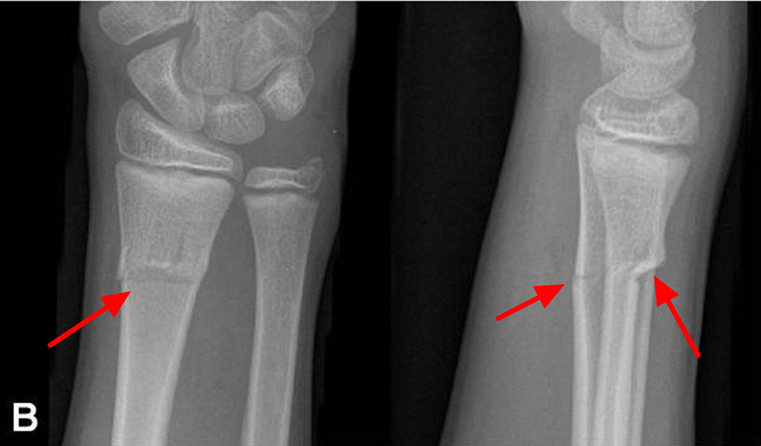 Buckle Torus Fracture of an Arm