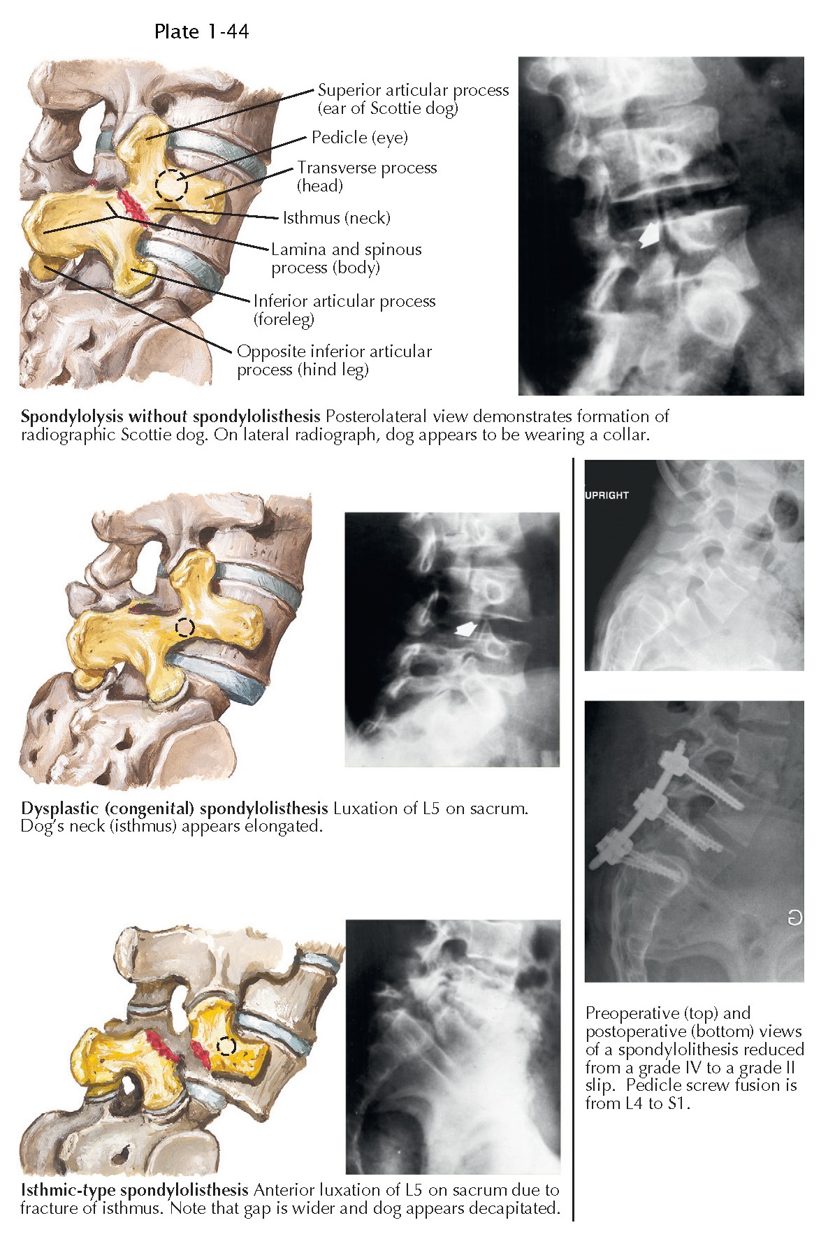 SPONDYLOLYSIS AND SPONDYLOLISTHESIS pediagenosis
