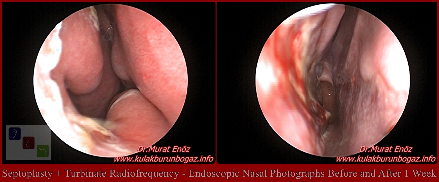 Featured image of post View 11 Turbinate Reduction Septoplasty Splints