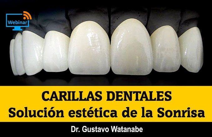 WEBINAR: CARILLAS DENTALES, solución estética de la Sonrisa - Dr. Gustavo Watanabe