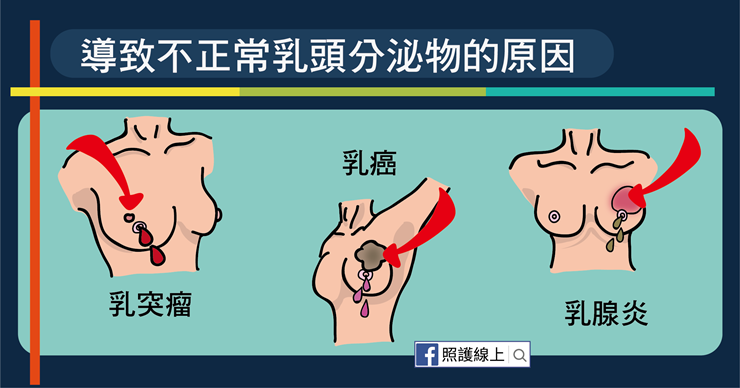 乳頭出現分泌物，到底正不正常？出現5症狀可能是「乳癌」