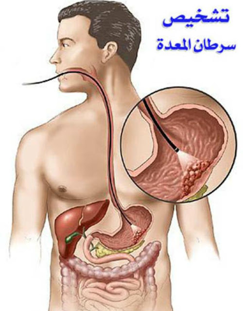يتم اكتشاف المرض عن طريق يتم اكتشاف المرض عن طريق